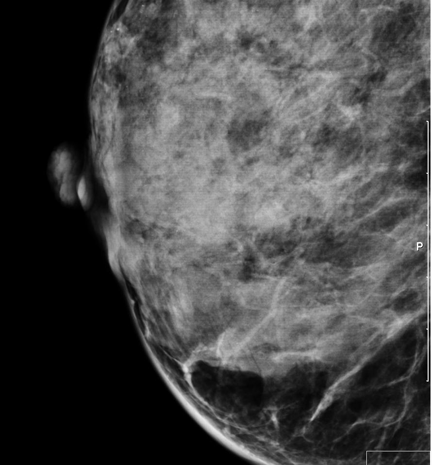 selenia grid artefact on RMLO.JPG